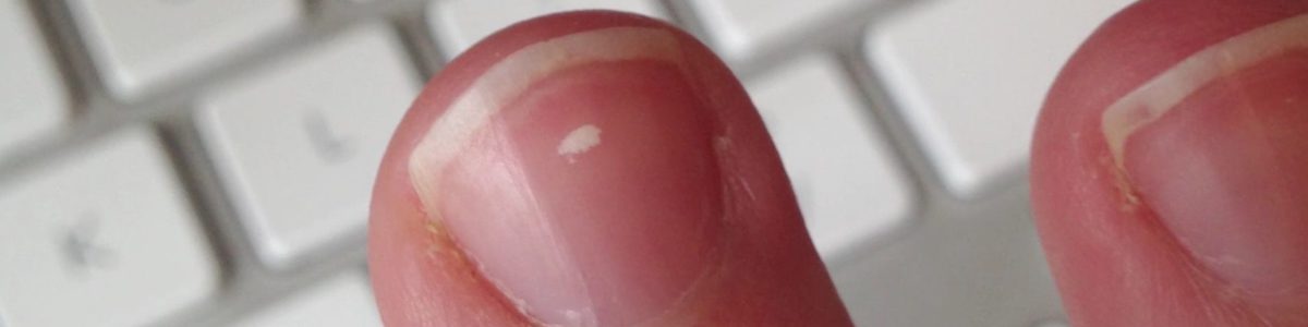 White Spots on nails