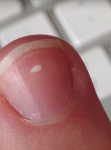 White Spots on nails